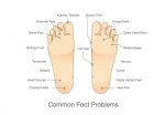 drawing of feet showing common foot problems 