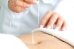 acupuncturist placing small needles in the tummy to help eliminate pain