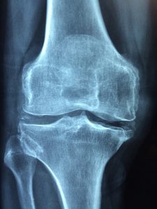 knee joint re arthritis