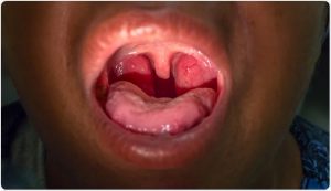 photo of tonsillitis